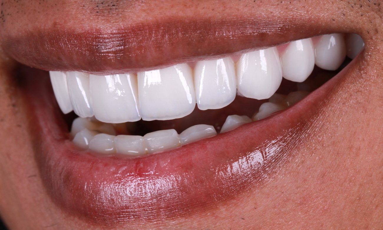 Dentes fixos após protocolo sobre implante - resultado Brandes