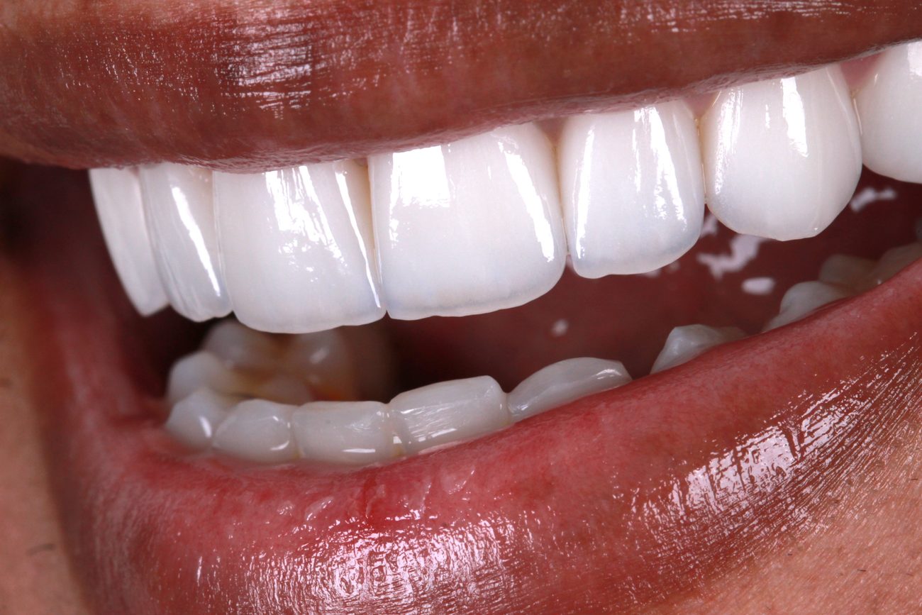 Sorriso reabilitado com prótese fixa - resultado Brandes