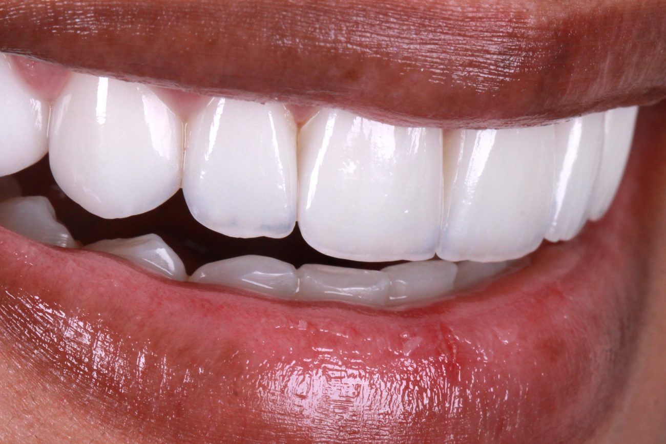 Detalhe dos dentes após reabilitação oral na Brandes