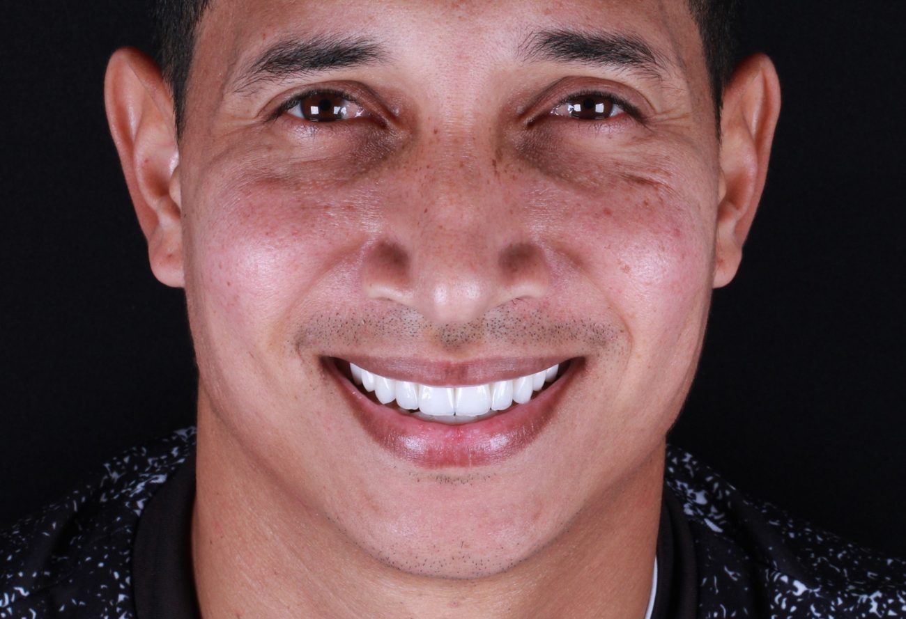 Resultado real de reabilitação oral: sorriso após protocolo sobre implante na Brandes